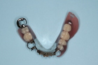 金属床義歯（金属の入れ歯）